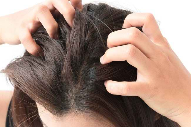 10 Kebiasaan Amazing yang Dapat Menyebabkan Gatal pada Rambut, Jangan Anggap Sepele!
