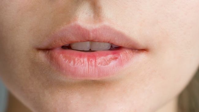 Bibir Kering Bisa Disebabkan Kekurangan Vitamin, Ini Penjelasannya Amazing (2025)